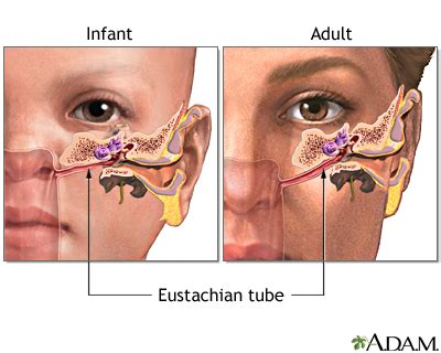 A middle ear infection develops when fluid builds up in the cavity behind the eardrum and a bacterial. Ear infection - chronic: MedlinePlus Medical Encyclopedia