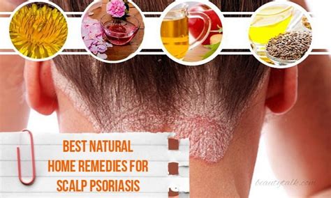 16 Best Natural Home Remedies For Scalp Psoriasis