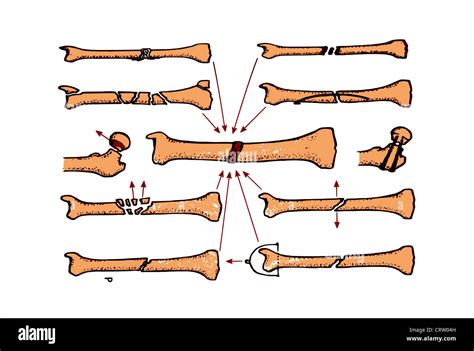 Complications Of Fracture Healing Stock Photo Alamy