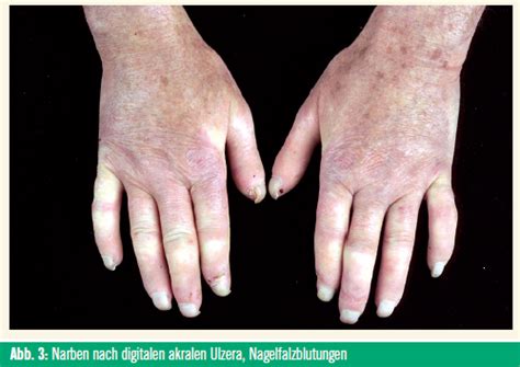 Meteorismus ist die medizinische bezeichnung eines blähbauches. Raynaud-Phänomen und Sklerodermie | Spectrum Dermatologie ...