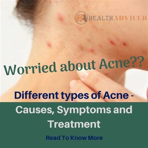 All About Acne Types Causes Signs Symptoms Treatment Kulturaupice