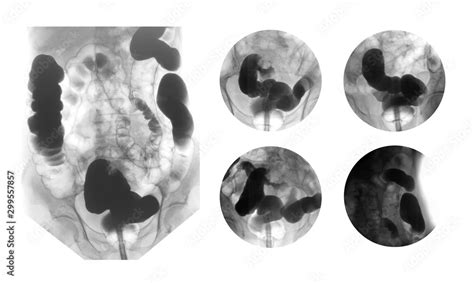 Lower Gastrointestinal Gi Tract Radiography Lower Gi Or Barium Enema