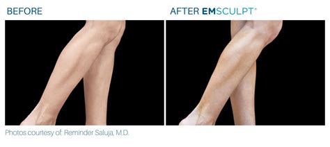 How To Sculpt And Tone Your Calves With Emsculpt