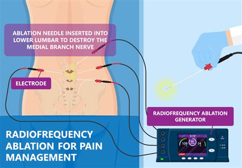 What Is Radiofrequency Ablation Southeast Pain Spine