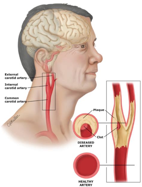 Location Carotid Arteries In Neck Arteria Carótida Externa Anatomía
