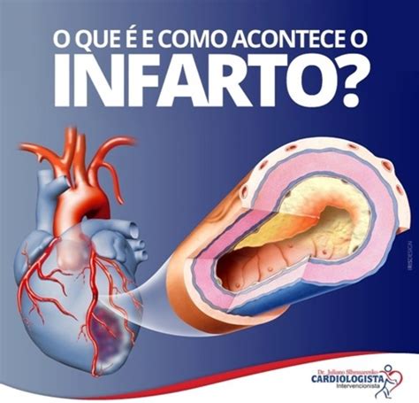 Algum episódio anteriormente validado de enfarte agudo do miocárdio? O que é e como acontece o infarto agudo do miocárdio ...