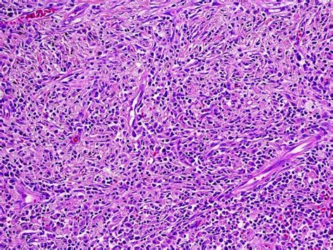 Pathology Outlines Inflammatory Myofibroblastic Tumor