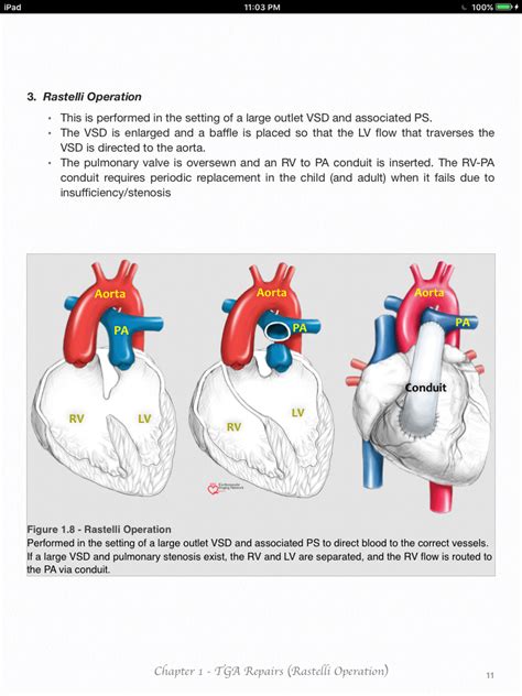 Tga Work Project Heart Failure Cardiac Arteries Human Body