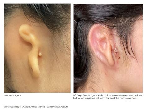 3d Ear Printed With Human Cells Implanted In Woman With Microtia