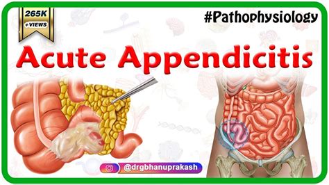 Code The Following Diagnosis Acute And Chronic Appendicitis