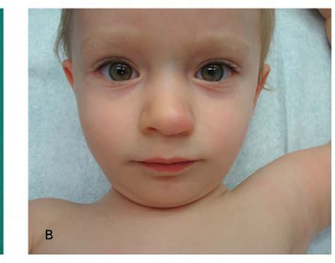 Figure 1 From Cyrano Nose Associated With Hepatic Hemangiomas