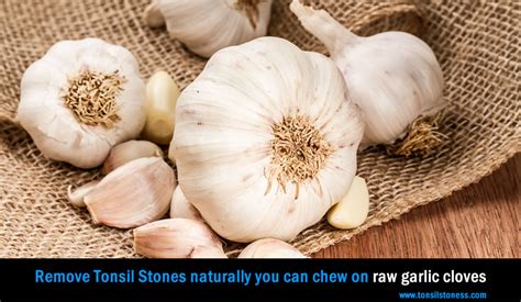 7 Natural Home Remedies To Cure Tonsil Stones
