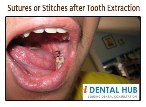 Sutures Or Stitches After Tooth Extraction Dental Care Identalhub