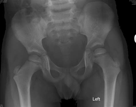 It will pass through the stages described above and finally heal. Normal x rays in Perthes disease -- Meadows et al. 2009 ...