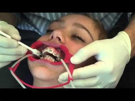 The average amount of time for braces is between 1 and 3. What does it feel like to get braces put on ...