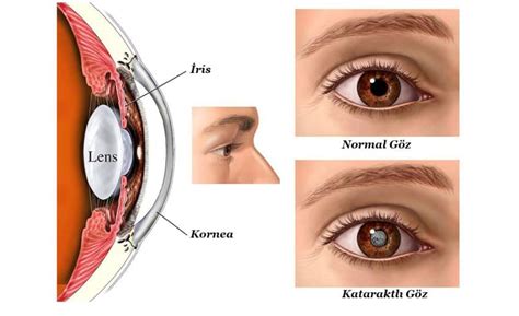 Poor vision caused by cataracts may also resu. Katarakt Ameliyatı Fiyatları 2018 - Katarakt Ameliyatı ...