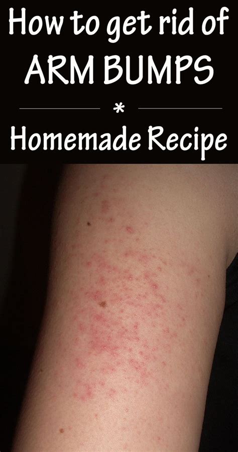 How To Get Rid Of Arm Bumps Homemade Recipe Diy Beauty Treatments