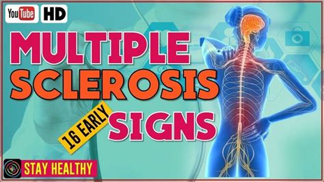 16 Early Signs And Symptoms Of Multiple Sclerosis You Should Know
