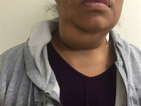 Lump On Front Of Neck