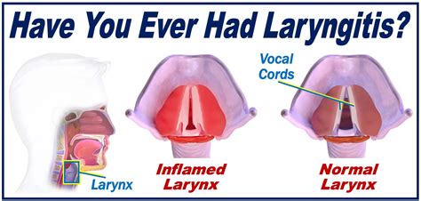 laryngitis causes symptoms treatment and prevention