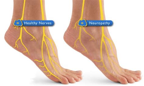 How It Works Neuropathy Treatment Oliver Wellness Center