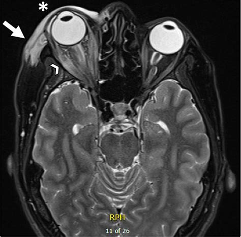 Cureus Carotid Cavernous Fistula In A Patient With Unilateral