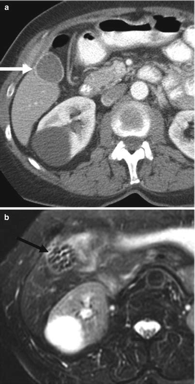 The Gallbladder Radiology Key