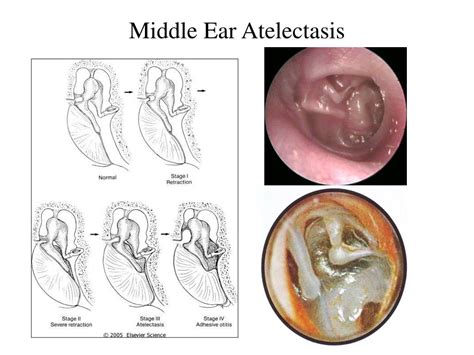 Ppt Chronic Otitis Media Com With And Without Cholesteatoma Pathophysiology Diagnosis And