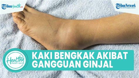 Waspadai Pergelangan Kaki Bengkak Akibat Gangguan Ginjal Begini