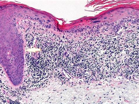 View 11 Bowenoid Actinic Keratosis Histology Wishquotearea