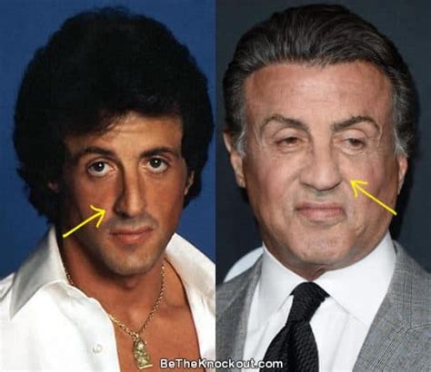 Sylvester Stallone Plastic Surgery Comparison Photos