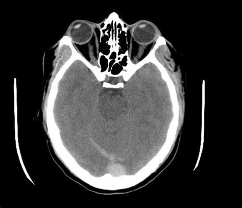 Cerebral Venous Sinus Thrombosis Ct Wikidoc