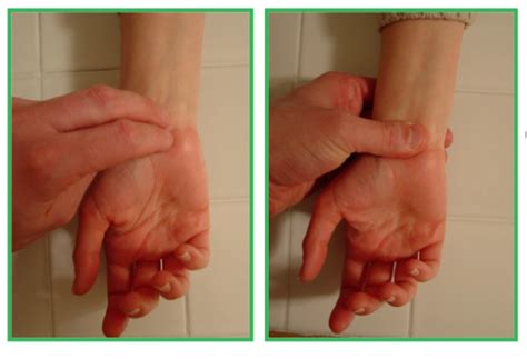What Causes Carpal Tunnel Syndrome Catching Health With Diane Atwood