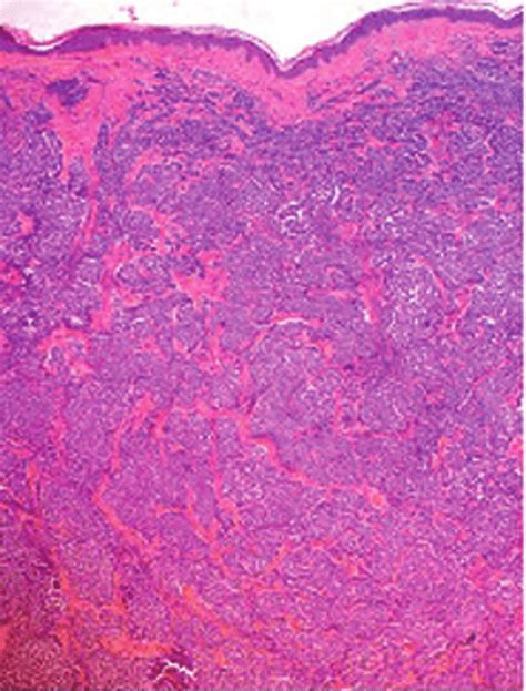 Small Cell Undifferentiated Merkels Cells Carcinoma Infiltrating The