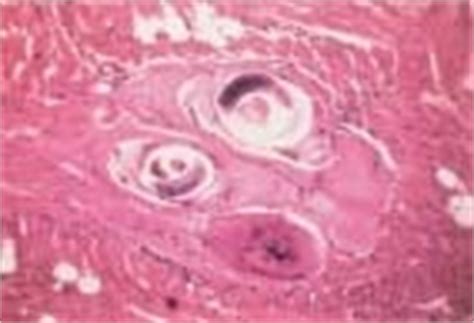 Sinusitis is an inflammation of the sinuses that can cause them to get blocked and filled with fluid. Trichinosis - body, last, causes, What Is Trichinosis?