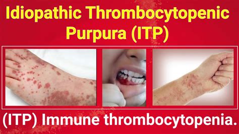 Itp Idiopathic Thrombocytopenic Purpura Immune Thrombocytopenia
