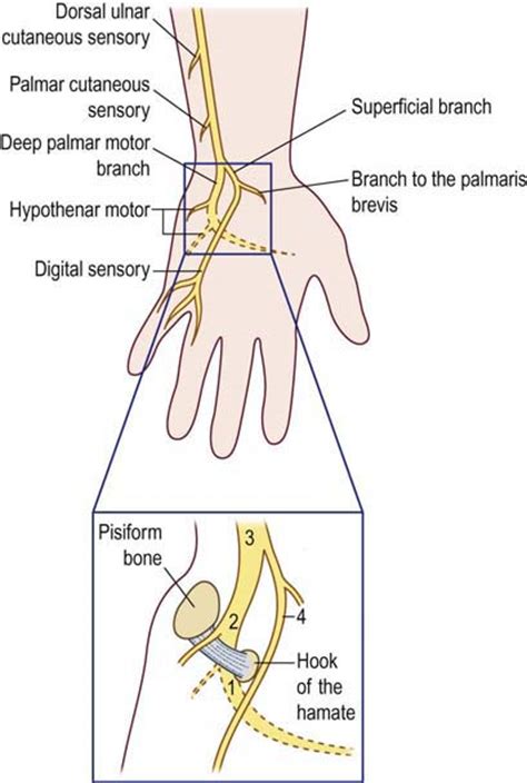 Ulnar Neuropathy At The Wrist Neupsy Key