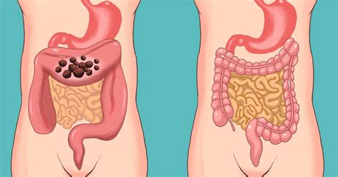 Some people may get regular treatment with chemotherapy, radiation therapy, or other treatments to try to control the cancer for as long as possible. 6 Natural Ways to Cleanse Your Colon and Preserve Your Youth