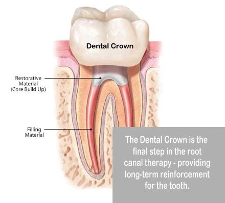 Root canal cost without insurance. Combined Cost of a Root Canal and Crown | Best Dental in Houston, Tx