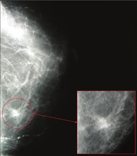Mammography Showed An Ill Defined High Density Spiculated Mass