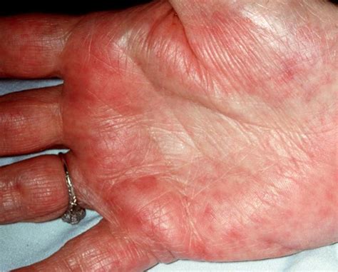 What Is The Most Common Cause Of Palmar Erythema Mastery Wiki