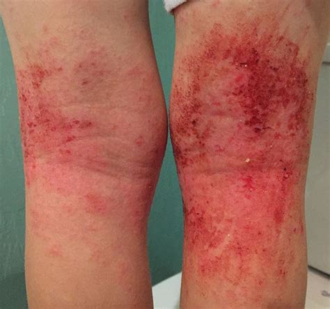 Two Weeks Tsw Topical Steroid Withdrawal Hydrocortisone Cream