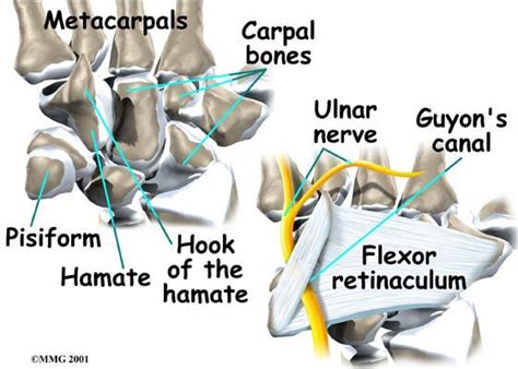 Ulnar Tunnel Syndrome Also Known As Guyon S Canal Syndrome Or