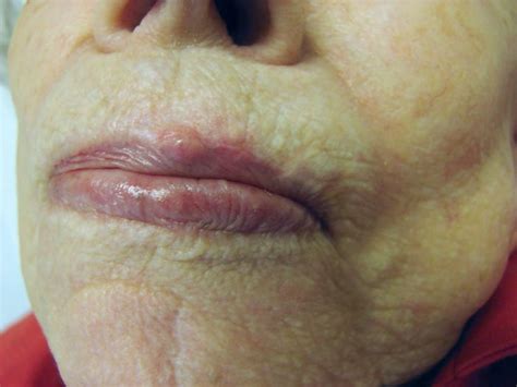 What Does Skin Cancer On Lips Look Like