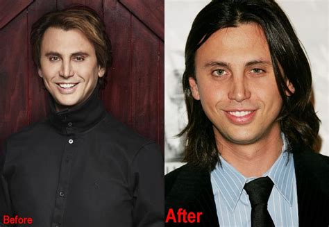 Jonathan Cheban Plastic Surgery Before And After Face Photos 2018