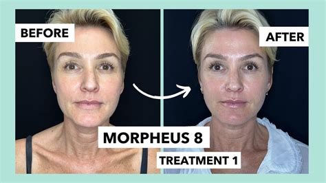 Morpheus 8 Treatment Non Surgical Facelift Before And After