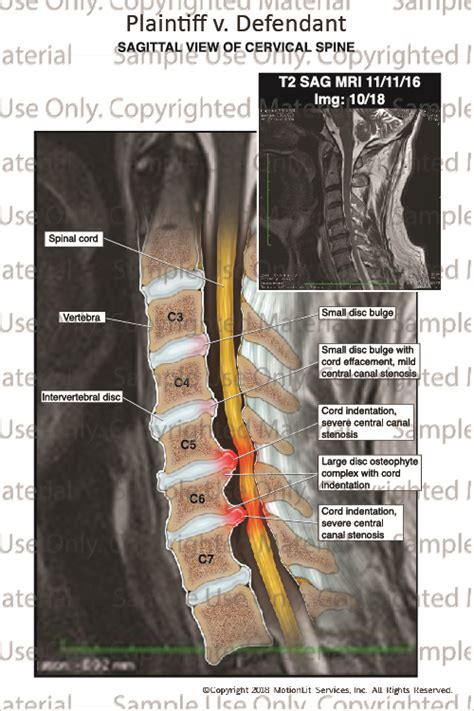 Cervical Disc Bulge Injury MRI Interpretation MotionLit