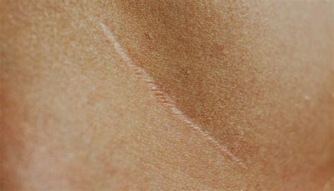 Caring For Scar Tissue After Cancer Surgery Md Anderson Cancer Center