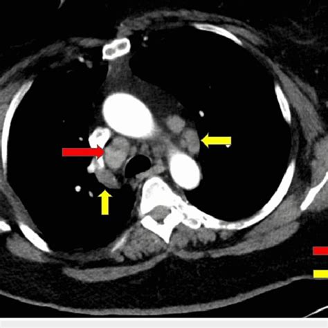 Ct Scan Of The Chest Revealed Mediastinal And Hilar Lymphadenopathy