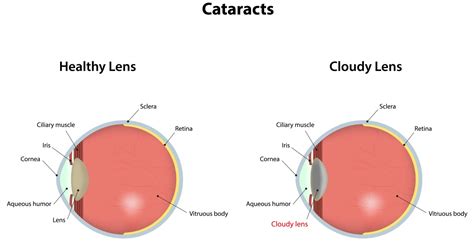 They say that lasik surgery has been around for a very long time. The Essential Guide To Cataract Surgery In Singapore (2019)